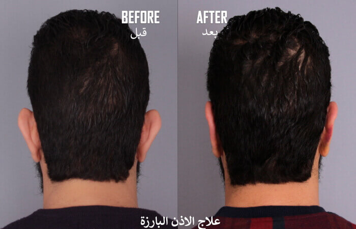 علاج الاذن البارزة