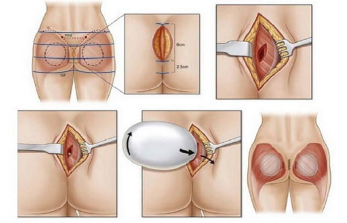 حشوة السيليكون لتكبير المؤخرة - تكبير المؤخرة بشكل دائم - تجميلي اسطنبول