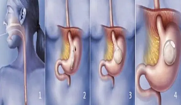 عملية وضع بالون في المعدة - تجميلي اسطنبول