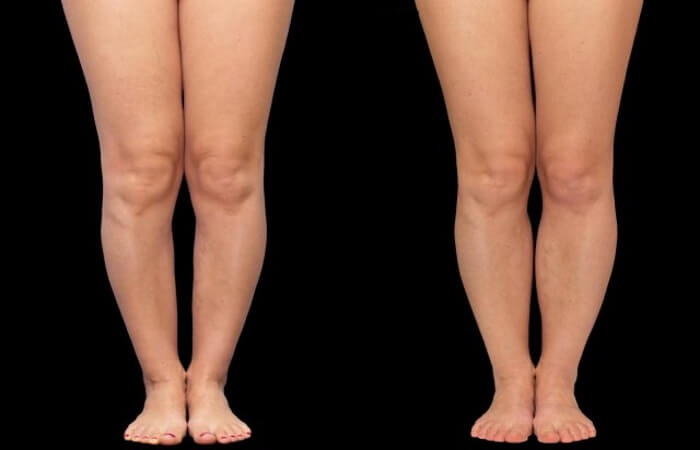 عملية تقوس الساقين