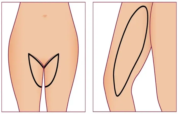 انواع عملية شد الفخذين - تجميلي اسطنبول