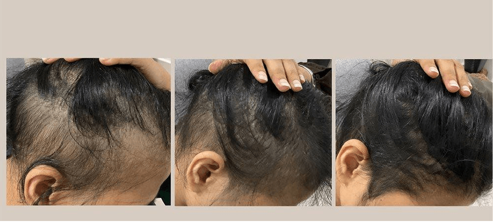 الاكسوزوم للشعر
